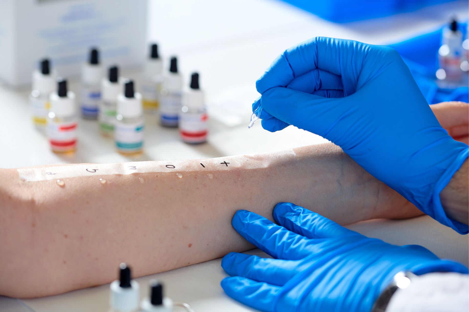 diagnostica Prick Test diagnostica Prick Test